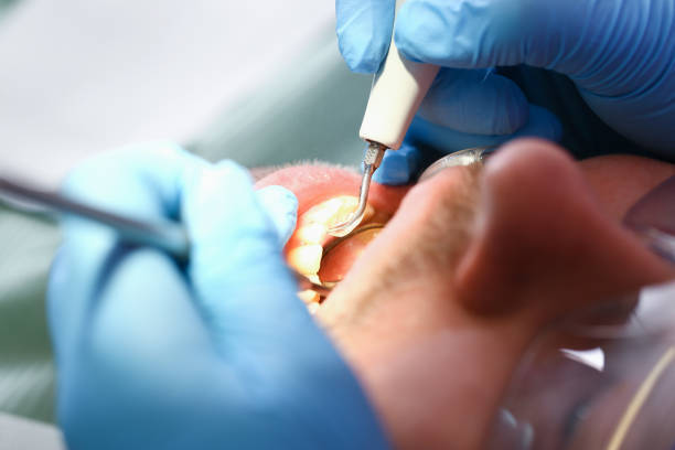 Best Emergency Dentist for Lost Fillings or Crowns in Willard, UT
